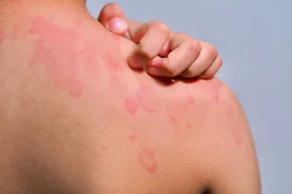 Pokrzywka u dziecka co podać: skuteczne metody łagodzenia objawów Pokrzywka u dziecka co podać: skuteczne metody łagodzenia objawów