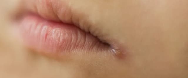 Krostki wokół ust u dziecka: skuteczne sposoby na łagodzenie podrażnień Krostki wokół ust u dziecka: skuteczne sposoby na łagodzenie podrażnień