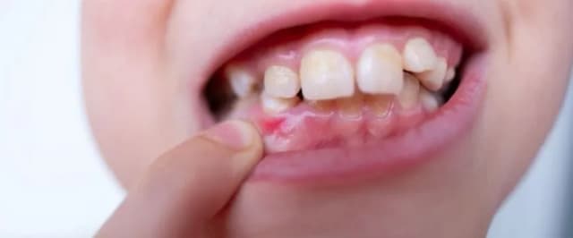 Skuteczne metody na zapalenie dziąseł u dziecka - uniknij bólu Skuteczne metody na zapalenie dziąseł u dziecka - uniknij bólu
