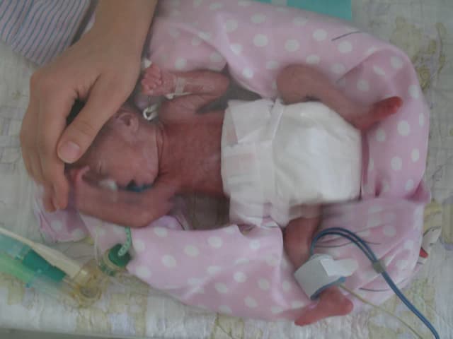 Jak wygląda dziecko urodzone w 22 tygodniu ciąży? Rozwój i szanse przeżycia wcześniaka Jak wygląda dziecko urodzone w 22 tygodniu ciąży? Rozwój i szanse przeżycia wcześniaka